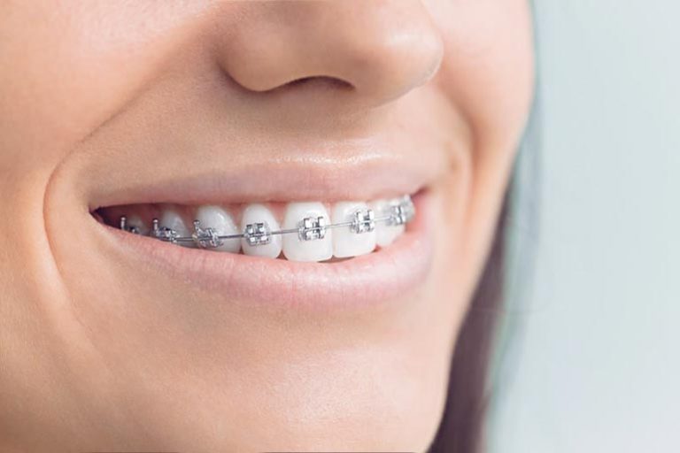 How Long Do Traditional Braces Take to Straighten Teeth?