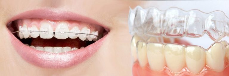 Traditional Braces Work Faster Than Invisalign